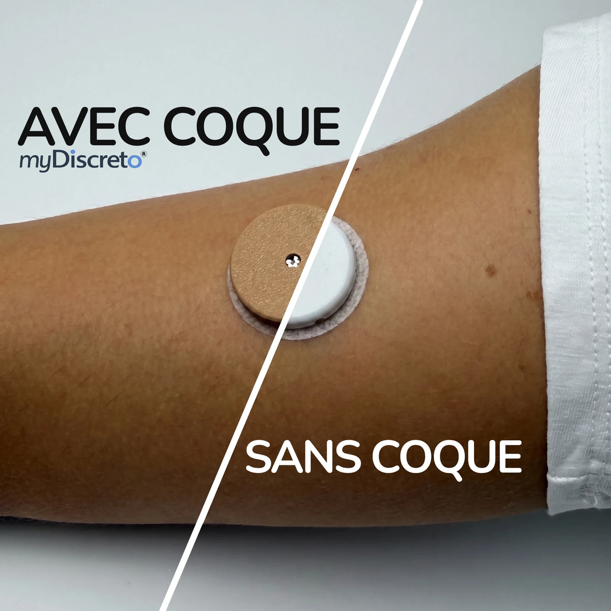 Bras portant un capteur FreeStyle Libre, montré sans coque d'un côté et recouvert d'une coque myDiscreto beige de l'autre