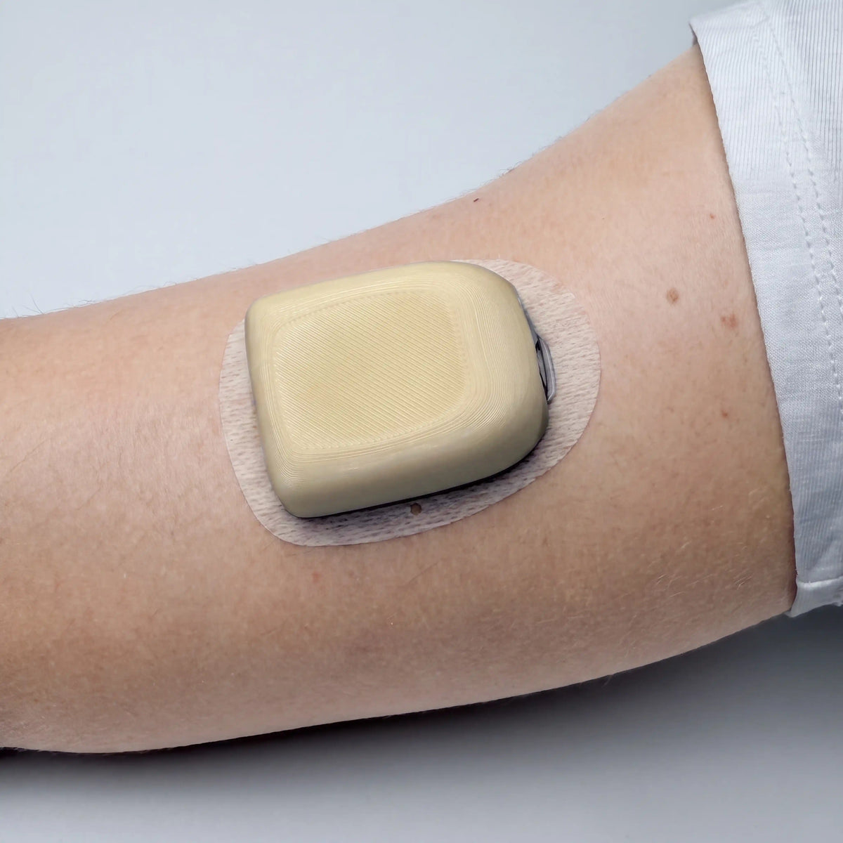 Coque beige clair posée sur un pod Omnipod 5, portée au bras